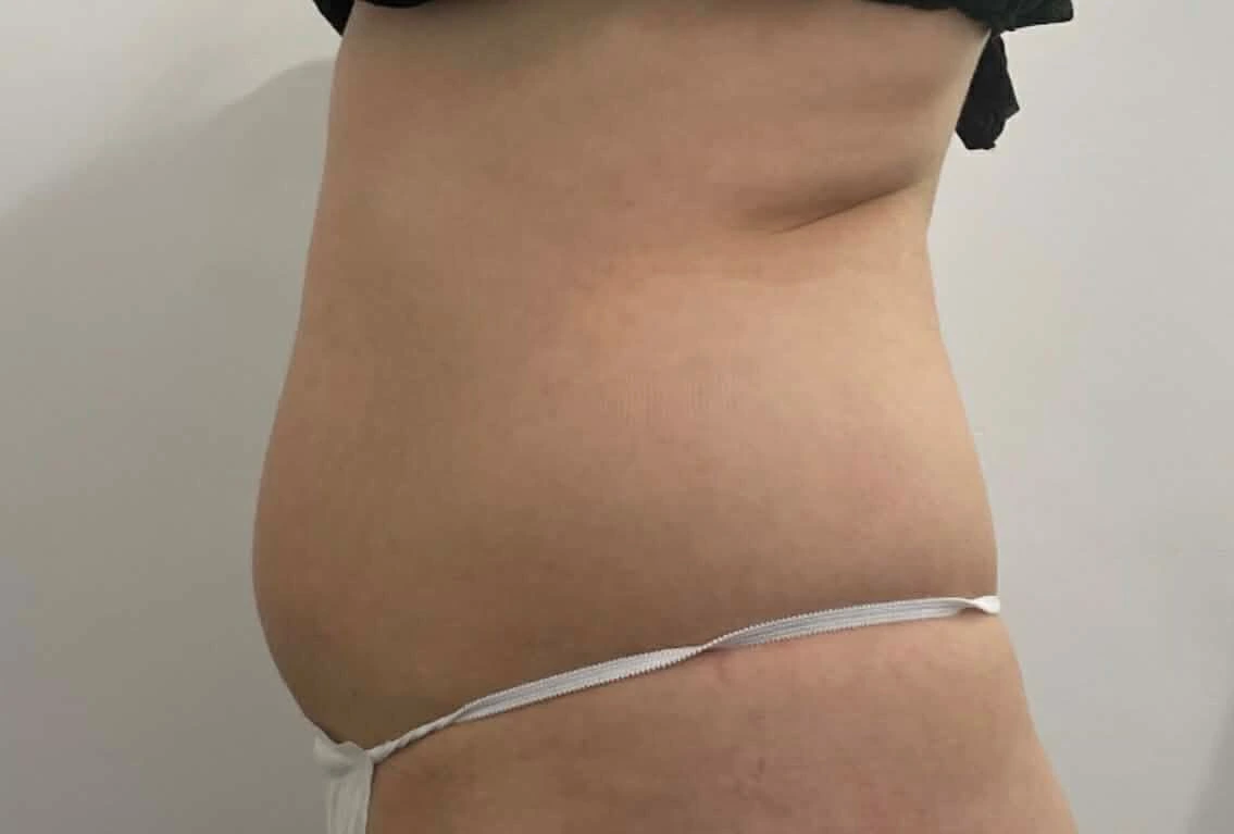 Ciało przed zabiegiem Magnifico